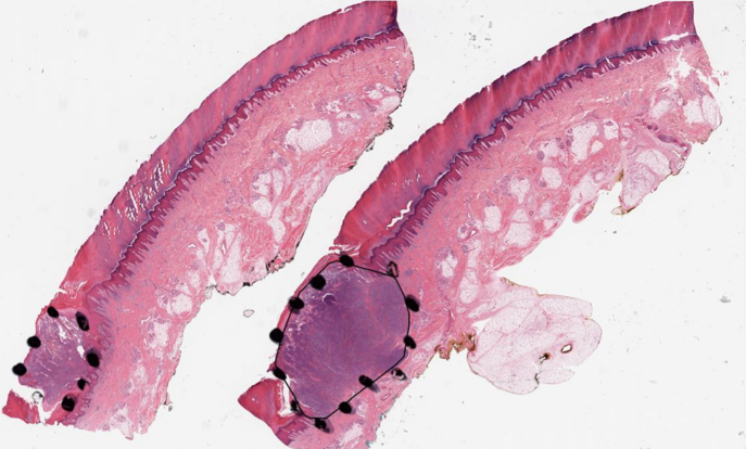 Boundary visualization for a melanoma sample