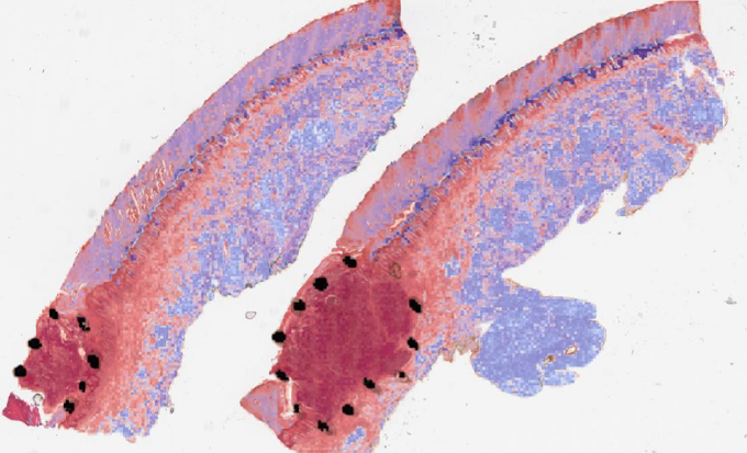 Heatmap visualization for a melanoma sample