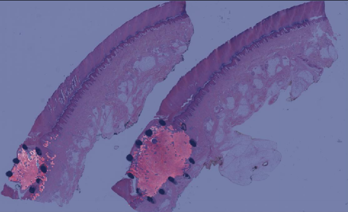 Overlay visualization for a melanoma sample