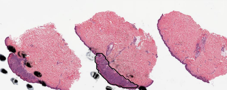 Boundary visualization for a nevus sample