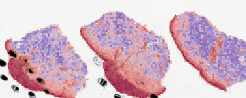 Heatmap visualization for a nevus sample