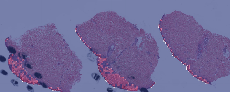 Overlay visualization for a nevus sample